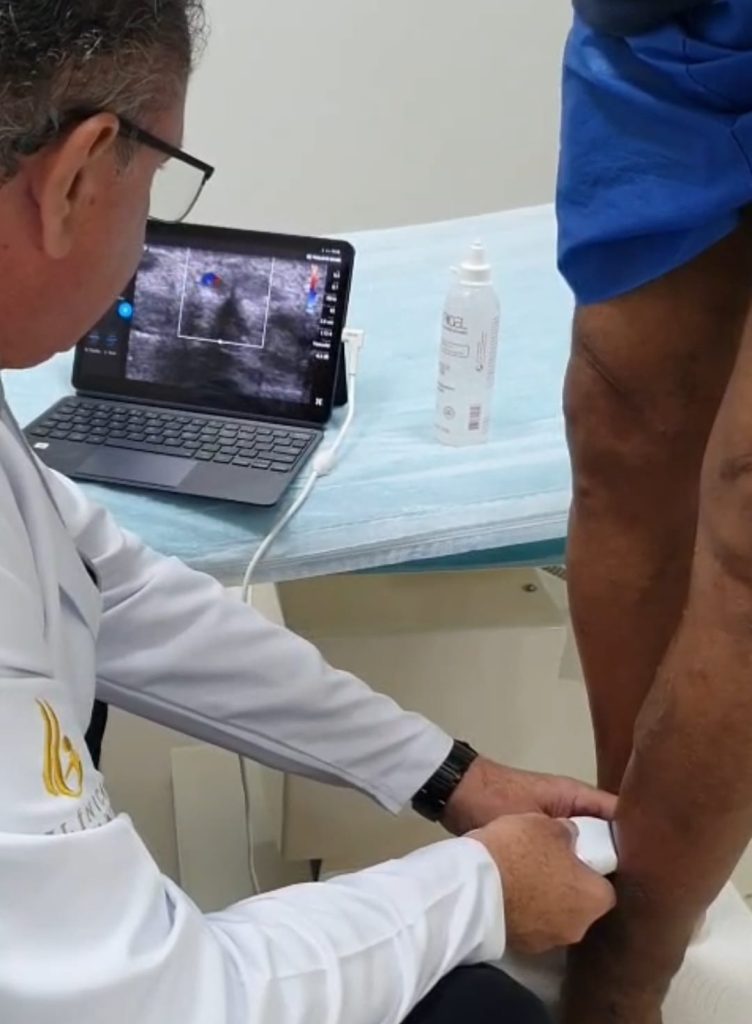 Realização do Dopler em varizes de paciente homem