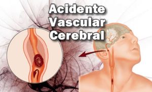 Verão aumenta risco de AVC: calor, desidratação e hábitos descuidados elevam casos no Brasil