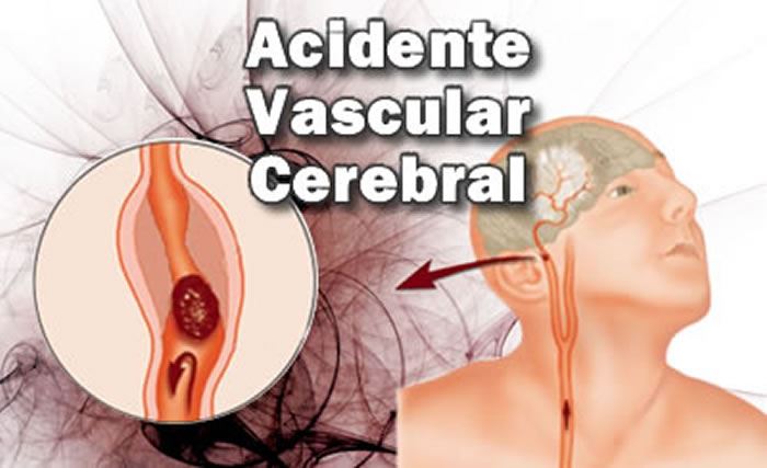Verão aumenta risco de AVC: calor, desidratação e hábitos descuidados elevam casos no Brasil